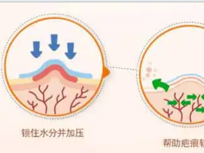 激光割双眼皮效果好吗_激光割双眼皮要多少钱